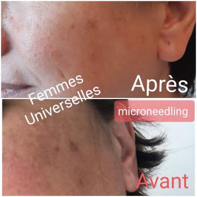 Formation Microneedling